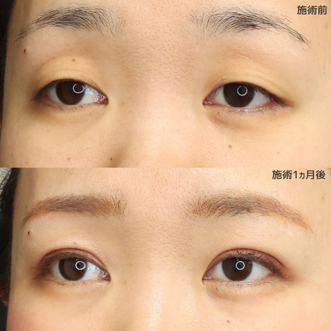 二重埋没法の症例写真 施術前後 