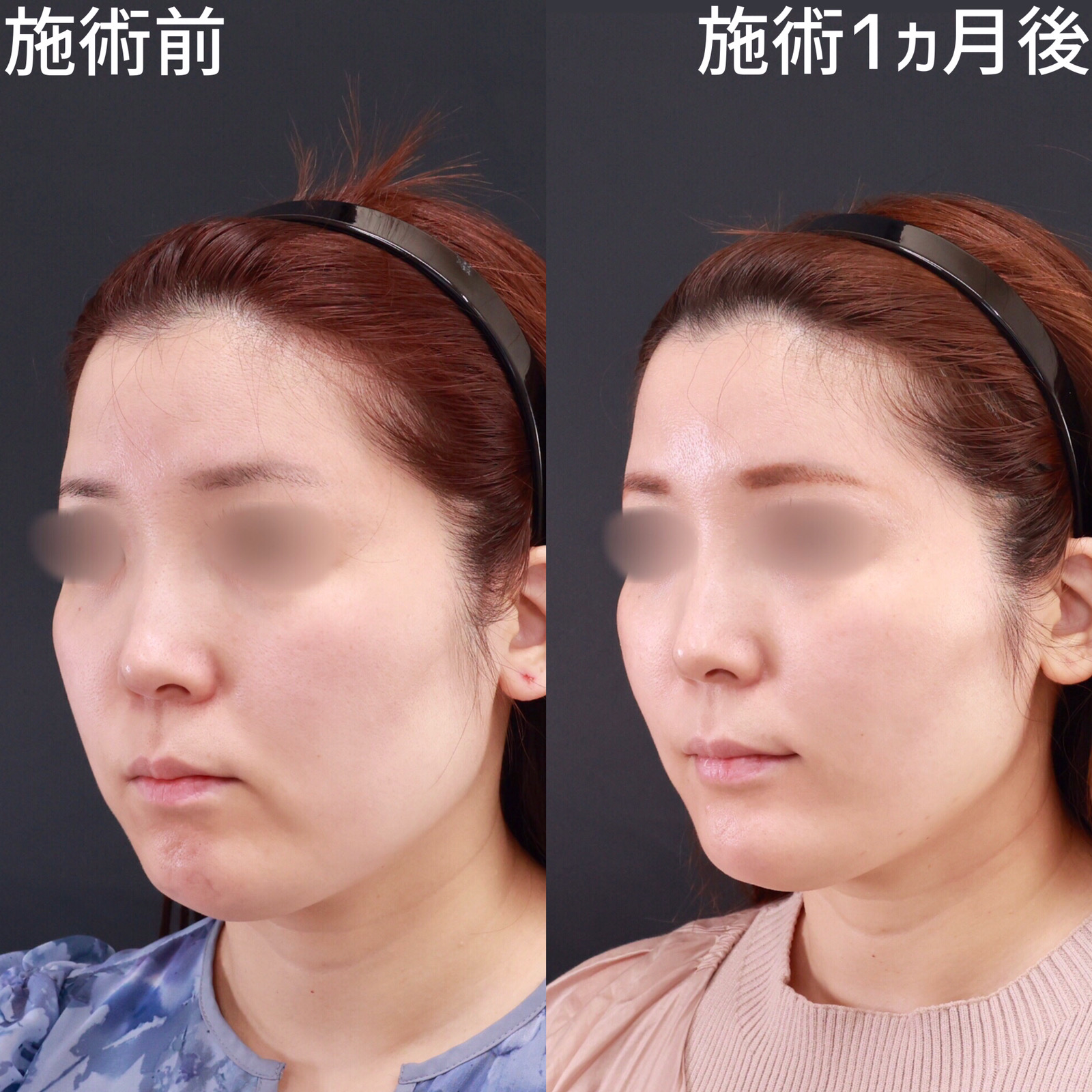 【糸リフト×脂肪除去】口元のもたつきが減り、マリオネットラインが改善！