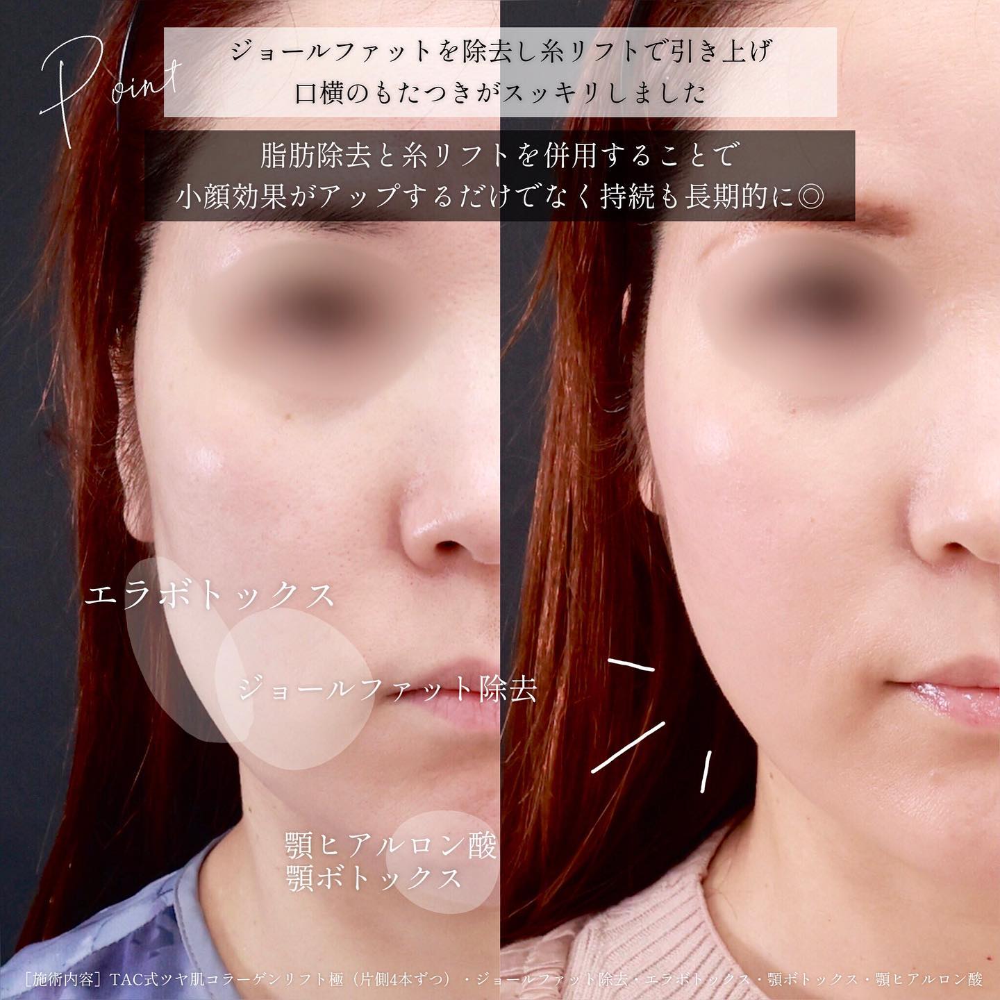 TAC式 ツヤ肌コラーゲンリフト®/ジョールファット除去/エラボトックス注射の症例写真 施術前後 