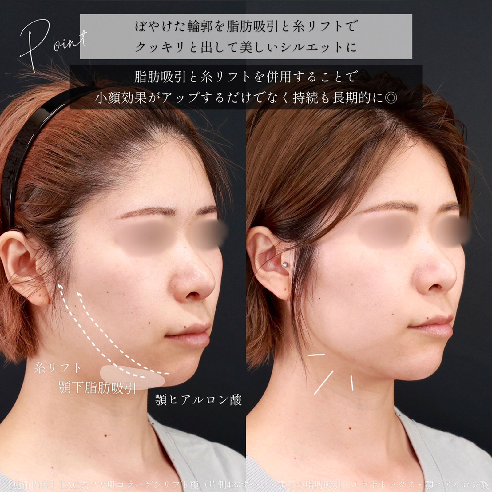 小顔整形｜パーフェクトフェイスライン/顔の脂肪吸引/エラボトックス注射の症例写真 施術前後 