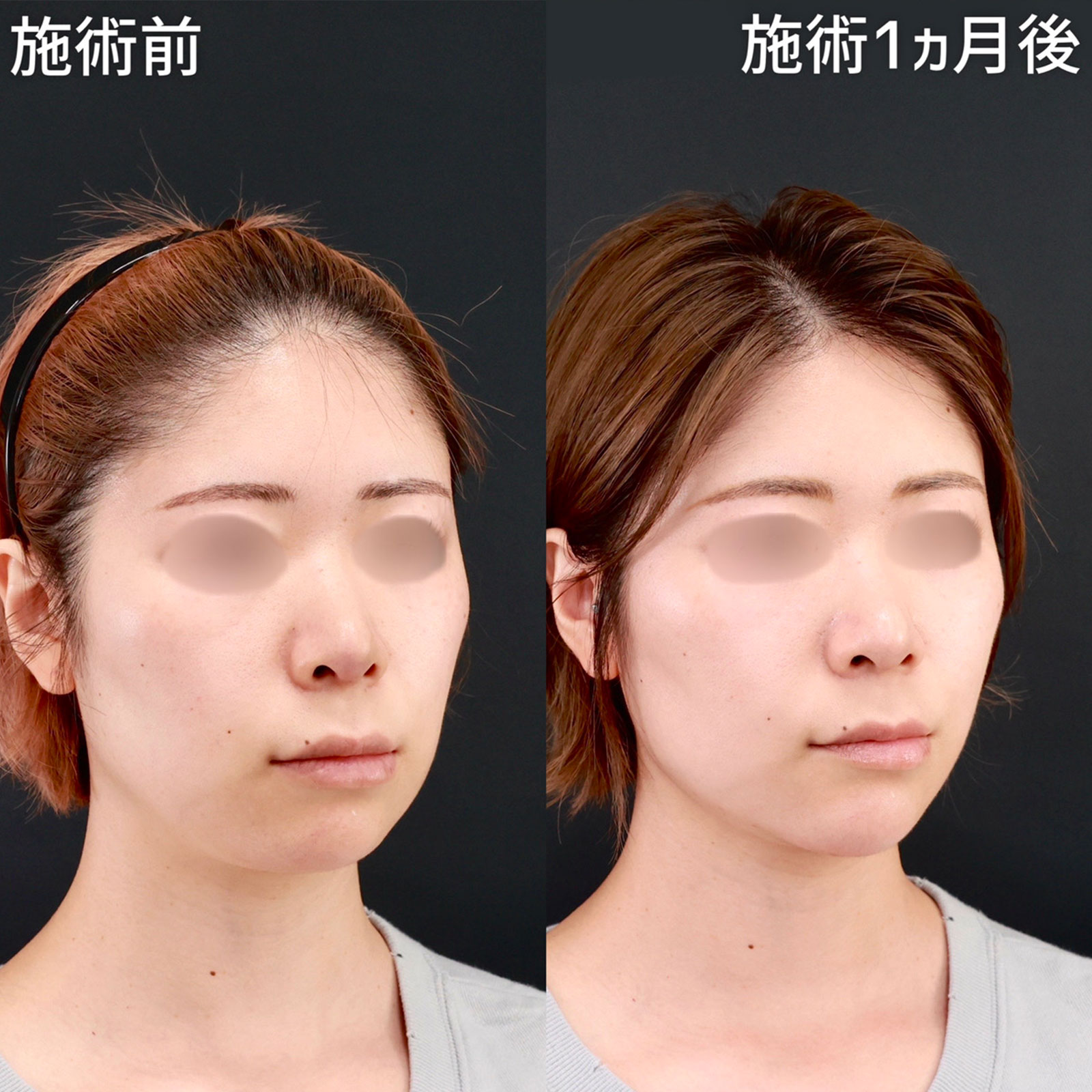 小顔整形｜パーフェクトフェイスライン/顔の脂肪吸引/エラボトックス注射の症例写真 施術前後 