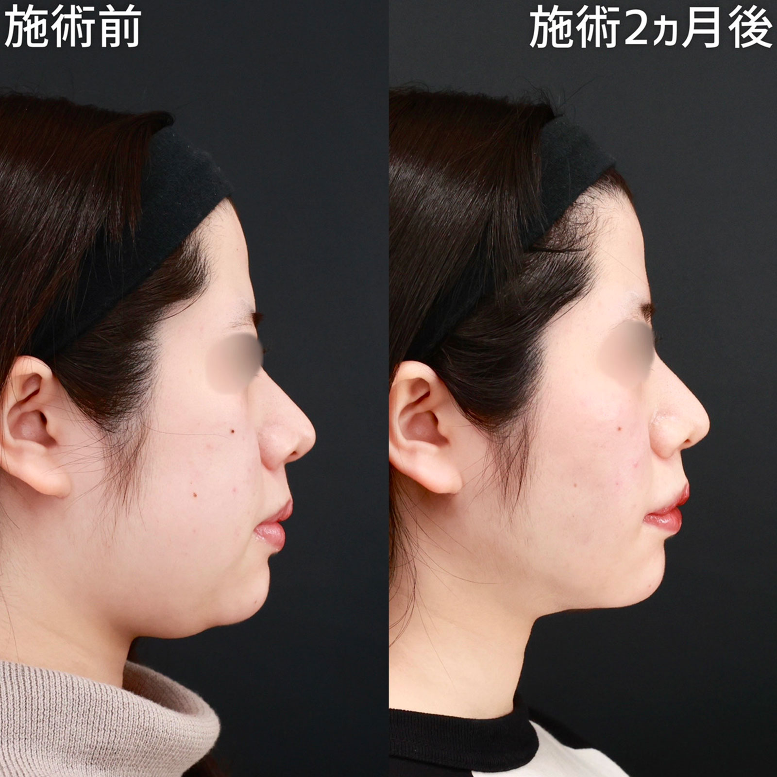 バッカルファット除去/ジョールファット除去/顎下の脂肪吸引の症例写真 施術前後 