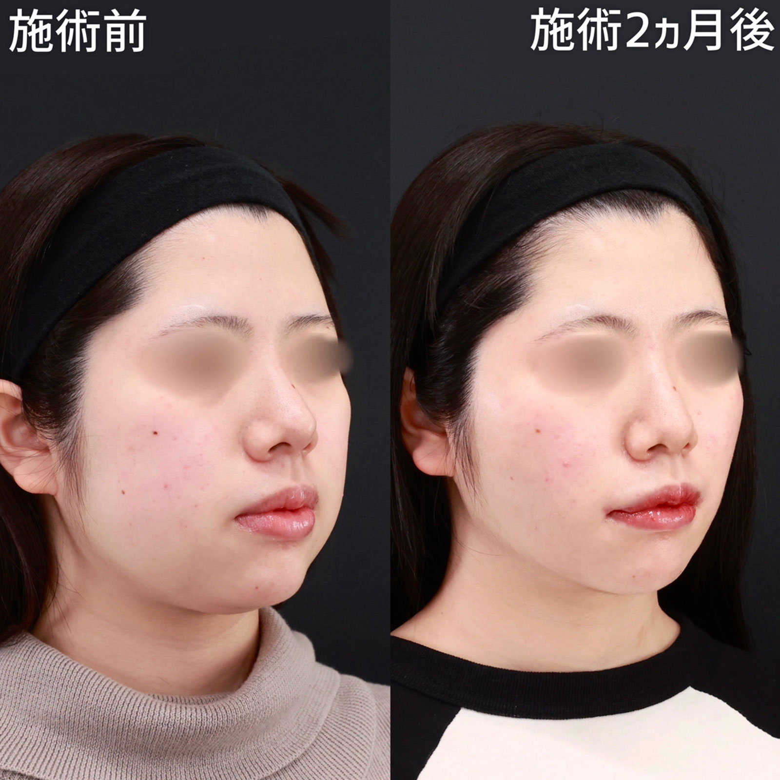 【お顔の脂肪吸引・脂肪除去】幼い印象から、大人っぽい印象に