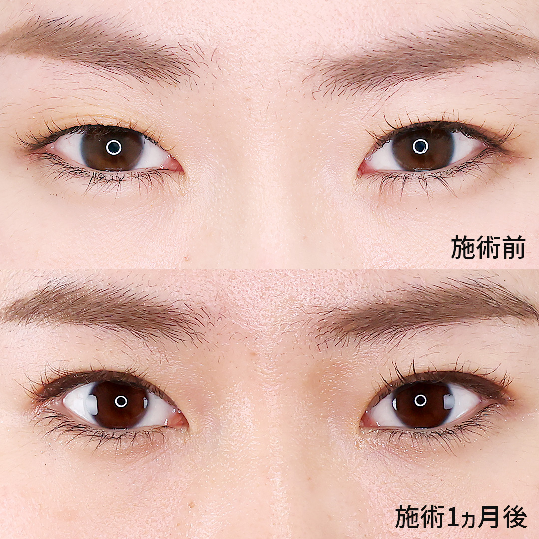 メイク映えする目元にアップグレード。村井先生の二重埋没法！