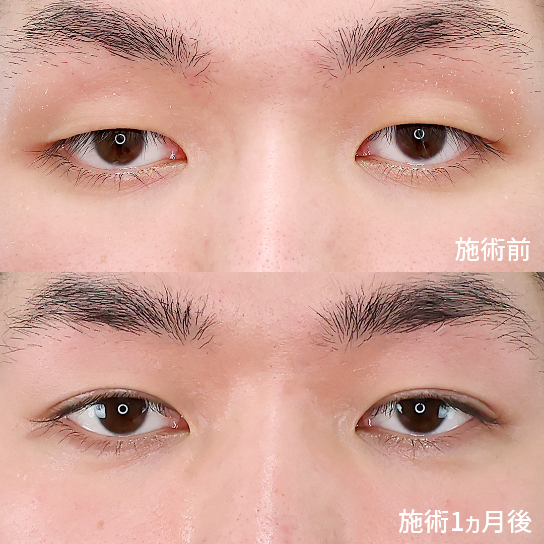 二重埋没法で目つきを改善！自然で優しい印象の目元へ。