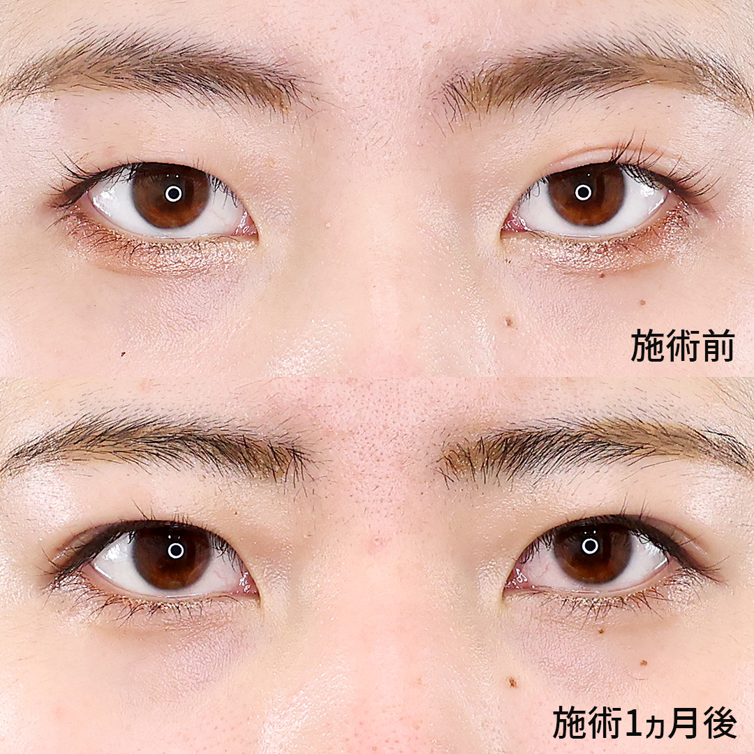 二重埋没法の症例写真 施術前後