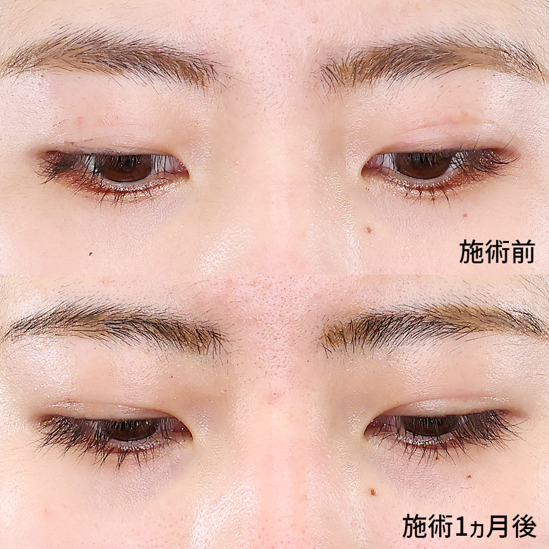 二重埋没法の症例写真 施術前後