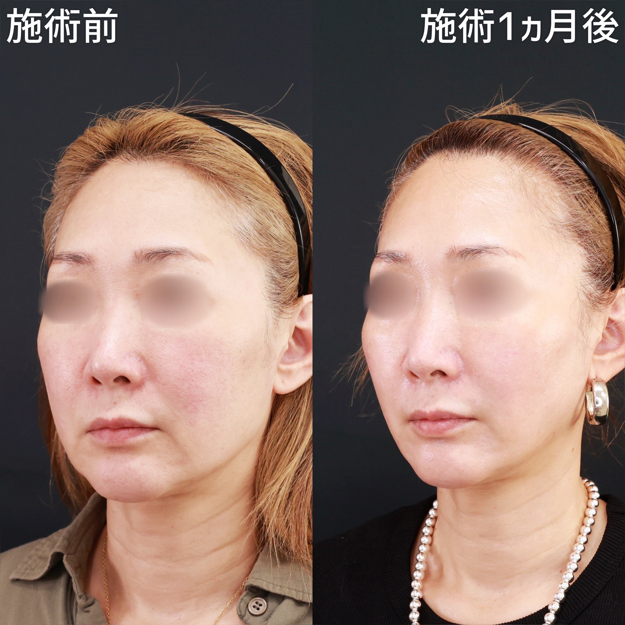 【糸リフト】面長な印象を、自然にスッキリ引き締める！