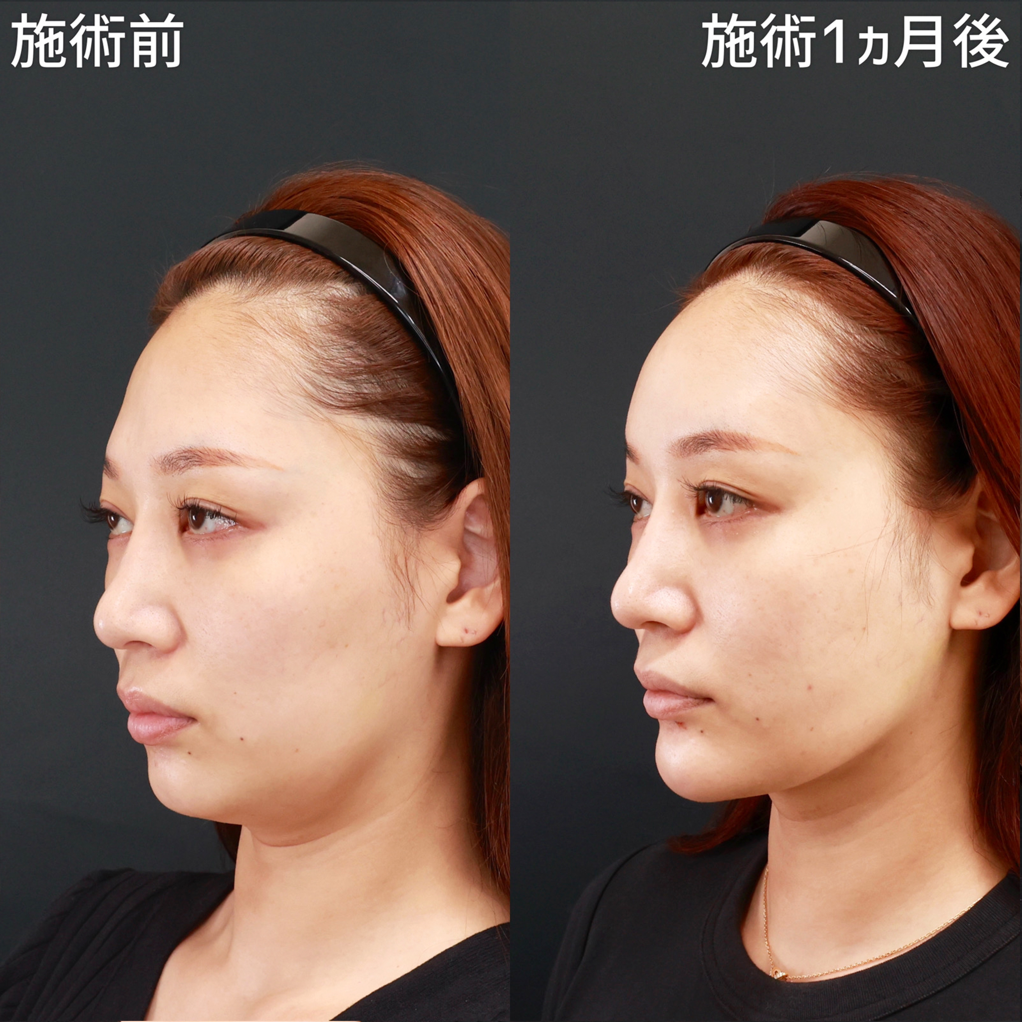 【小顔整形＆脂肪注入】最強のアンチエイジング治療ならこの2つ！