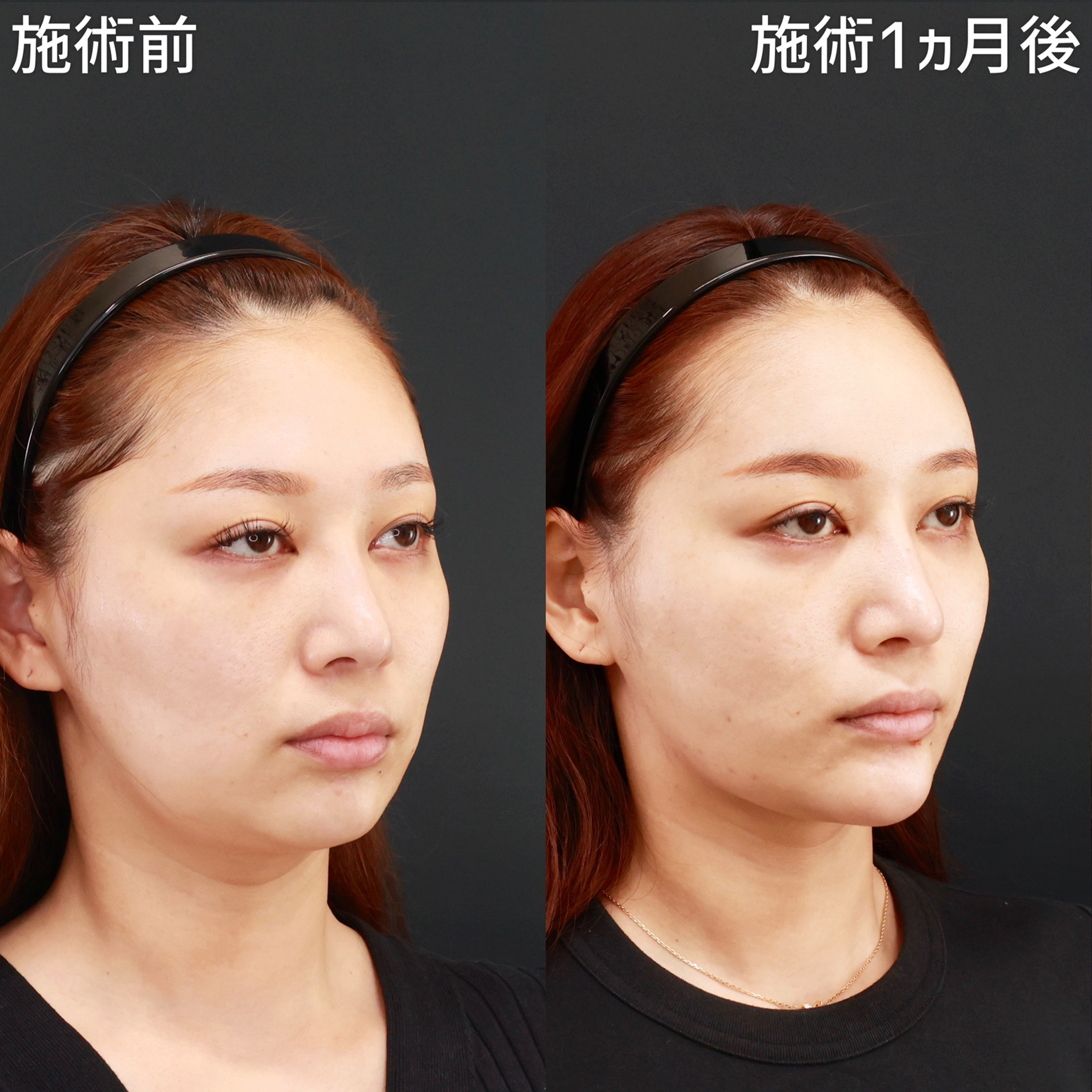 小顔整形｜パーフェクトフェイスライン/ジョールファット除去/Lラインファット除去（エラ下脂肪除去）の症例写真 施術前後 