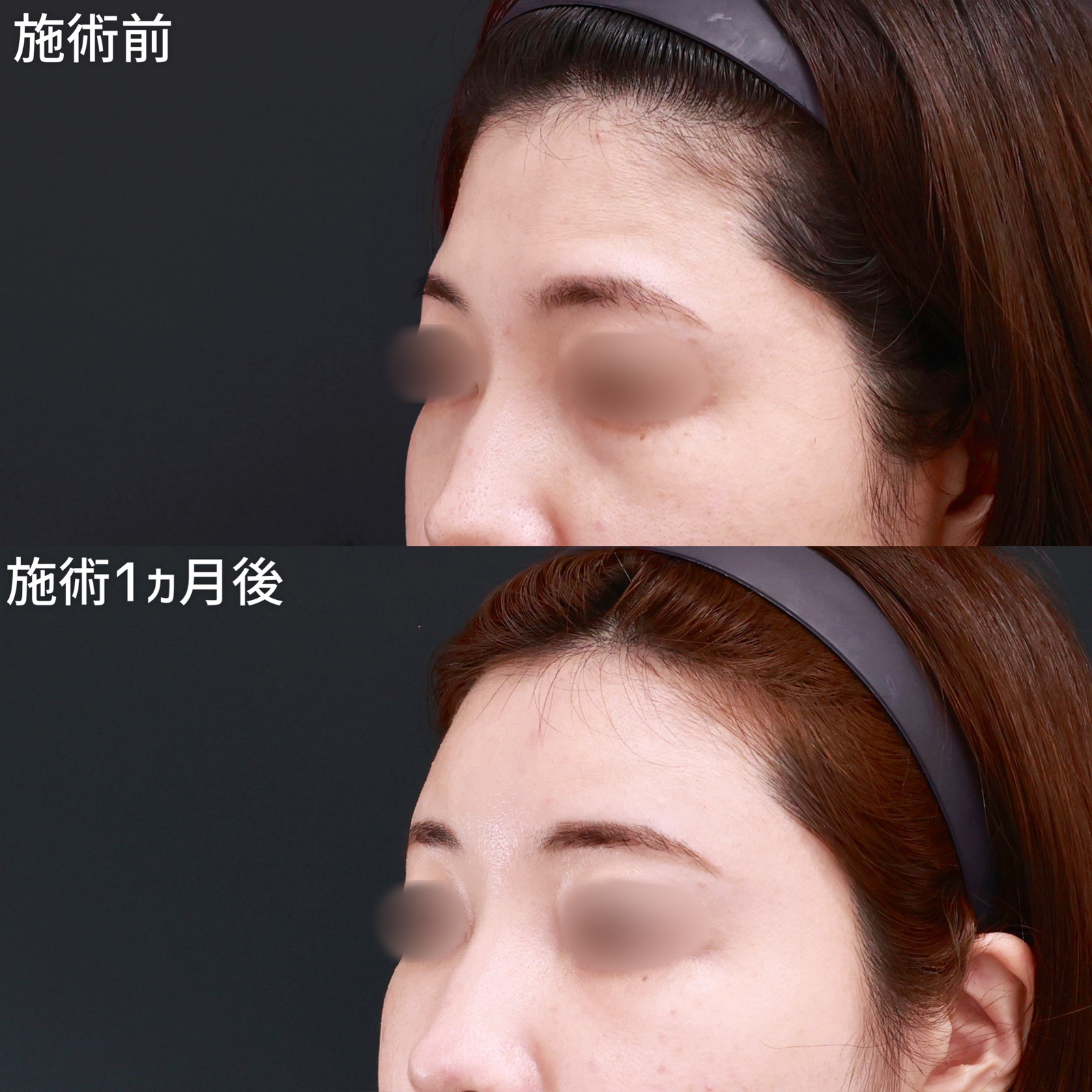 【オルチャンデコ】コンデンスリッチ脂肪注入でおでこの痩せをなくす！