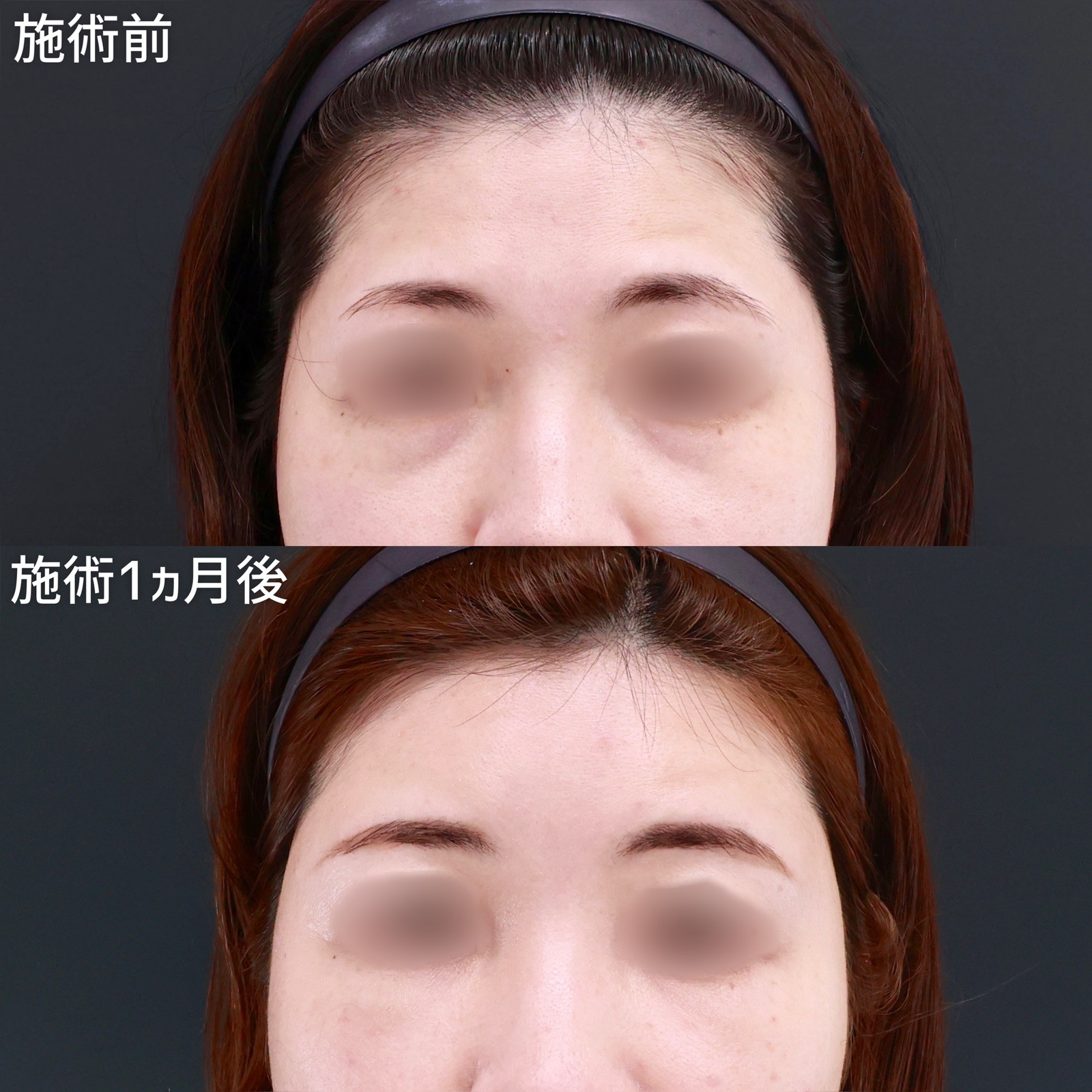 顔の脂肪注入(コンデンスリッチフェイス)/下眼瞼脱脂術（目の下のたるみ取り・目の下の脂肪ふくらみ取り）の症例写真 施術前後 