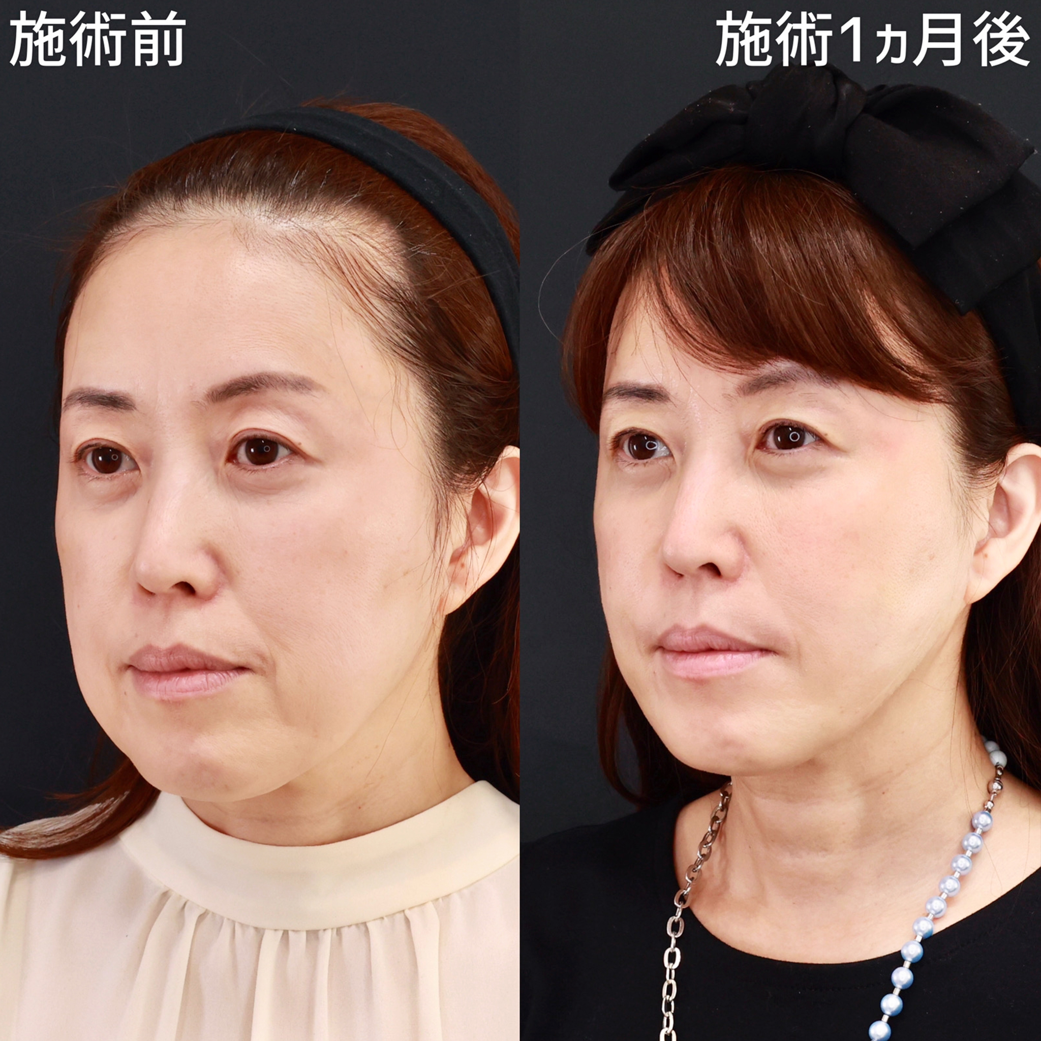 【ジョールファット除去＋糸リフト】ブルドック顔を改善して、若々しい印象に！