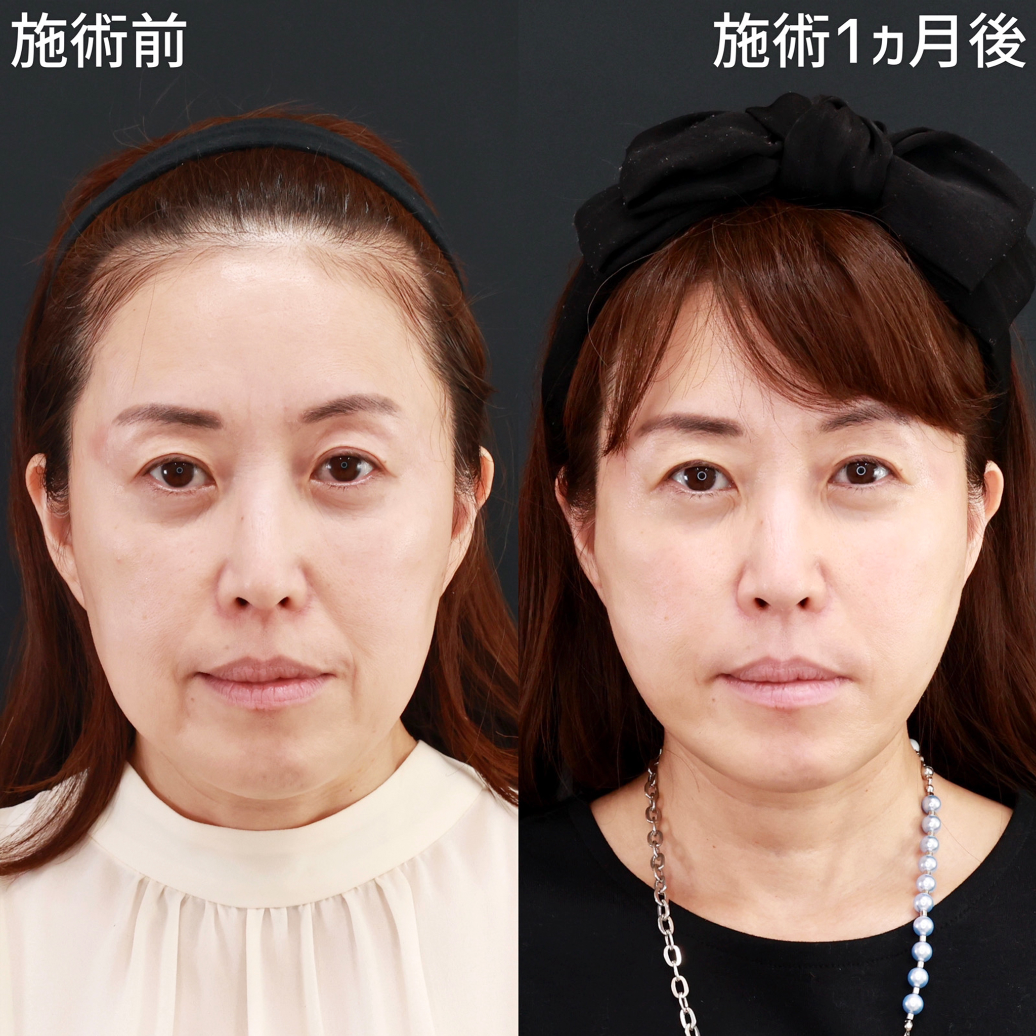 ジョールファット除去/ほうれい線のヒアルロン酸注射/TAC式 ツヤ肌コラーゲンリフト®の症例写真 施術前後 