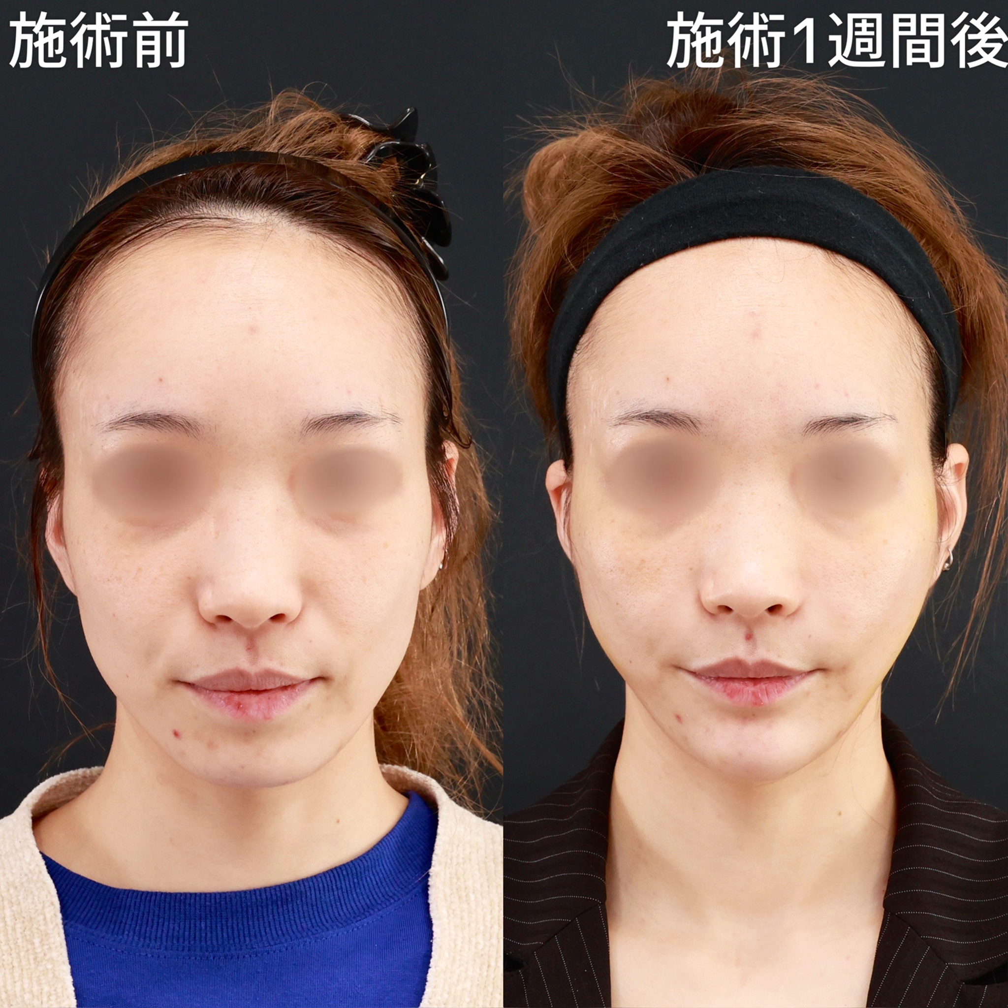 脂肪溶解注射/TAC式 ツヤ肌コラーゲンリフト®/ほうれい線のヒアルロン酸注射の症例写真 施術前後