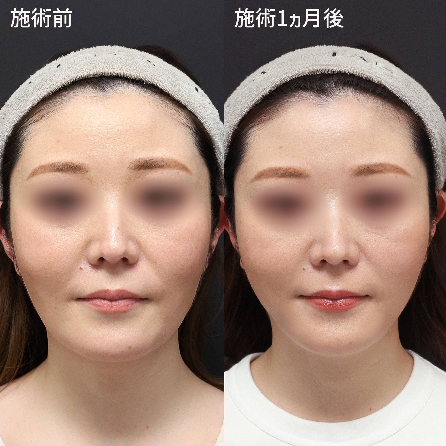 整形感の出ない自然な仕上がり！スッキリとしたフェイスラインをつくる施術を紹介。