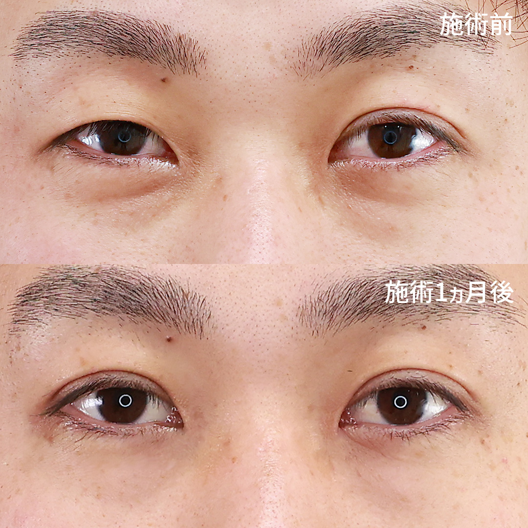 左右差がバッチリ改善!より自然な仕上がりの二重埋没法、【クィックコスメリング】