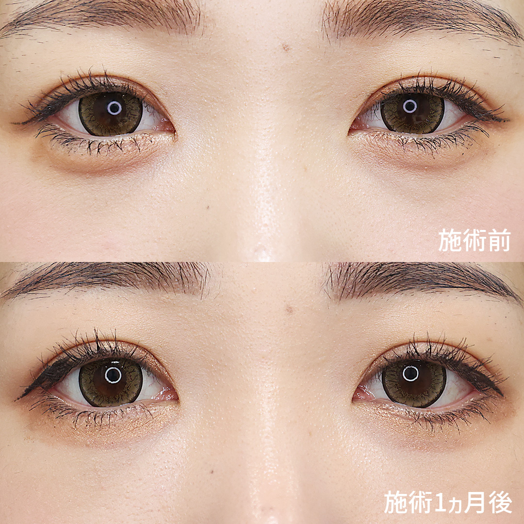 自然な【タレ目形成】で一層魅力的な目元へ