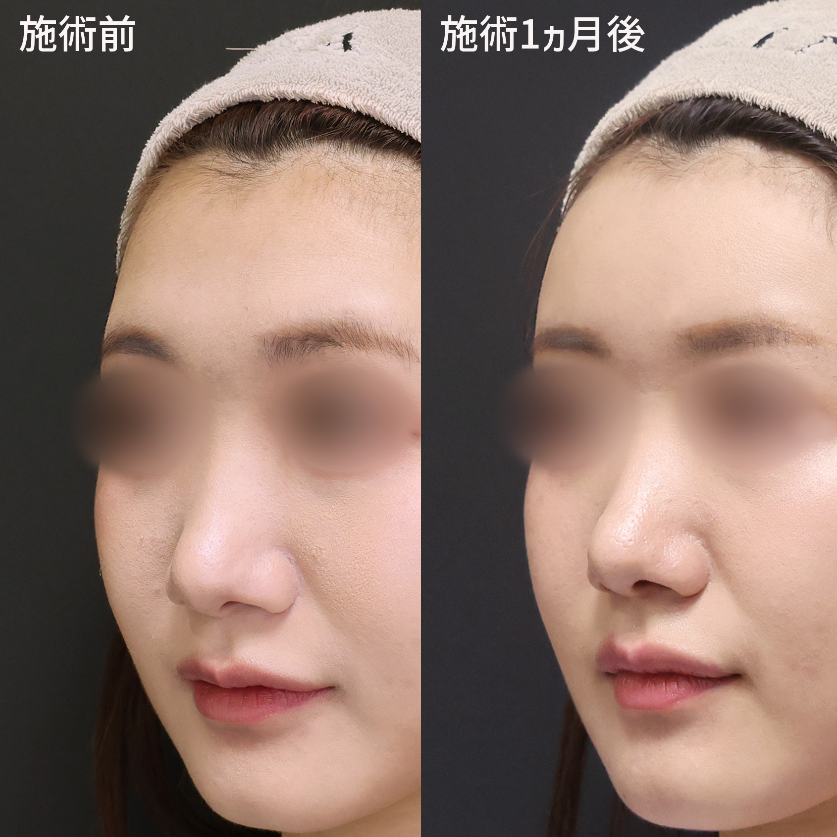 女性的な印象がアップする【オルチャンデコ形成】丸みのある美しい額へ