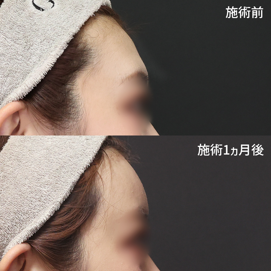 おでこの脂肪注入（オルチャンデコ形成）の症例写真 施術前後 