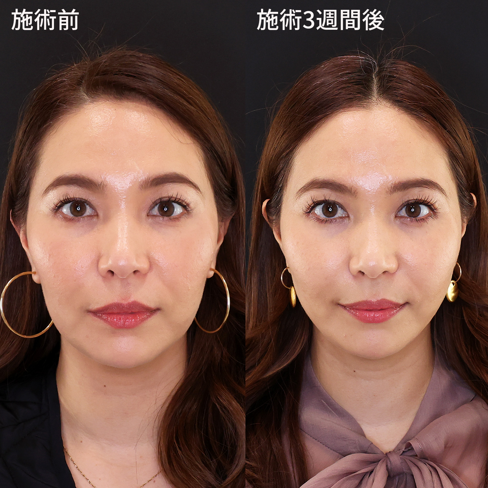 もたつき解消！【糸リフト】でシャープな小顔を手に入れる！