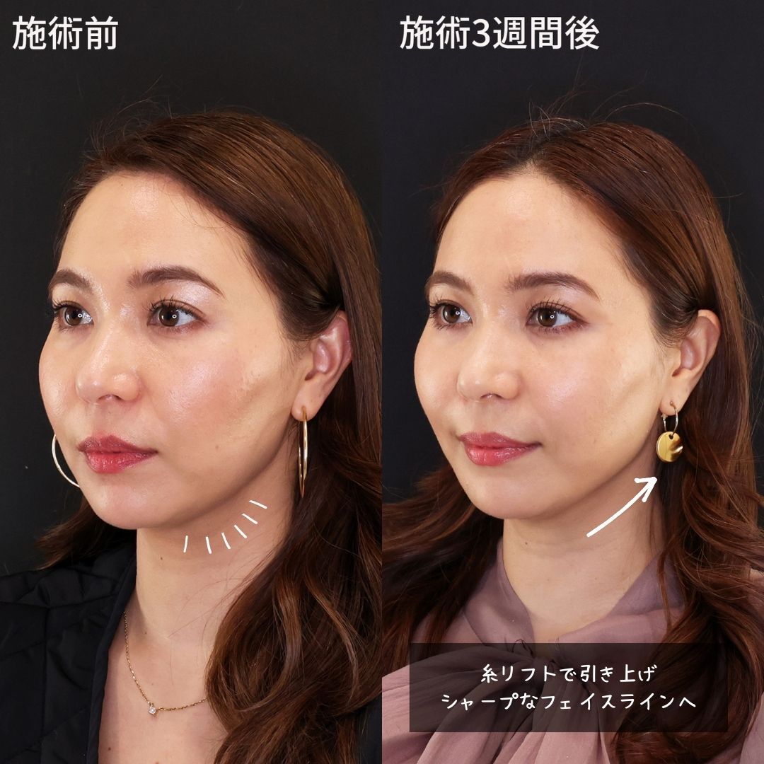 TAC式 ツヤ肌コラーゲンリフト®の症例写真 施術前後 