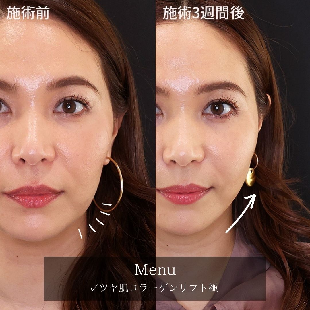 TAC式 ツヤ肌コラーゲンリフト®の症例写真 施術前後 