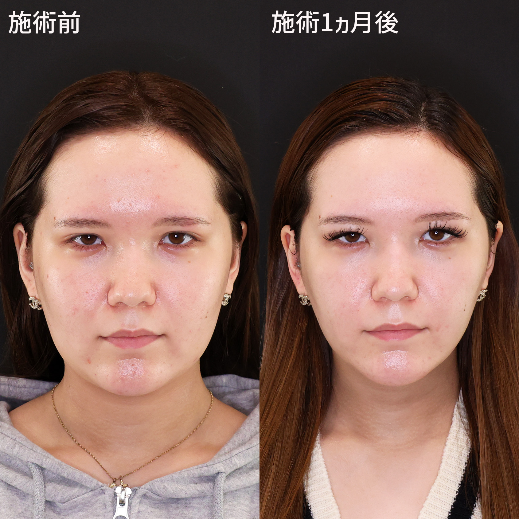 顔痩せ複合施術で別人級小顔へ！【糸リフト×脂肪除去】