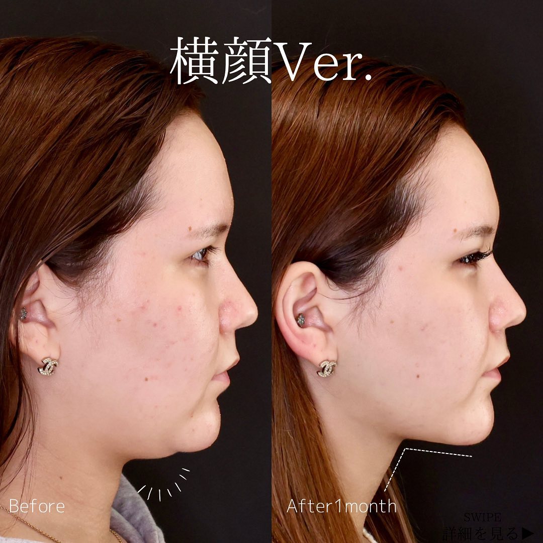 TAC式 ツヤ肌コラーゲンリフト®/ジョールファット除去/メーラーファット除去の症例写真 施術前後 