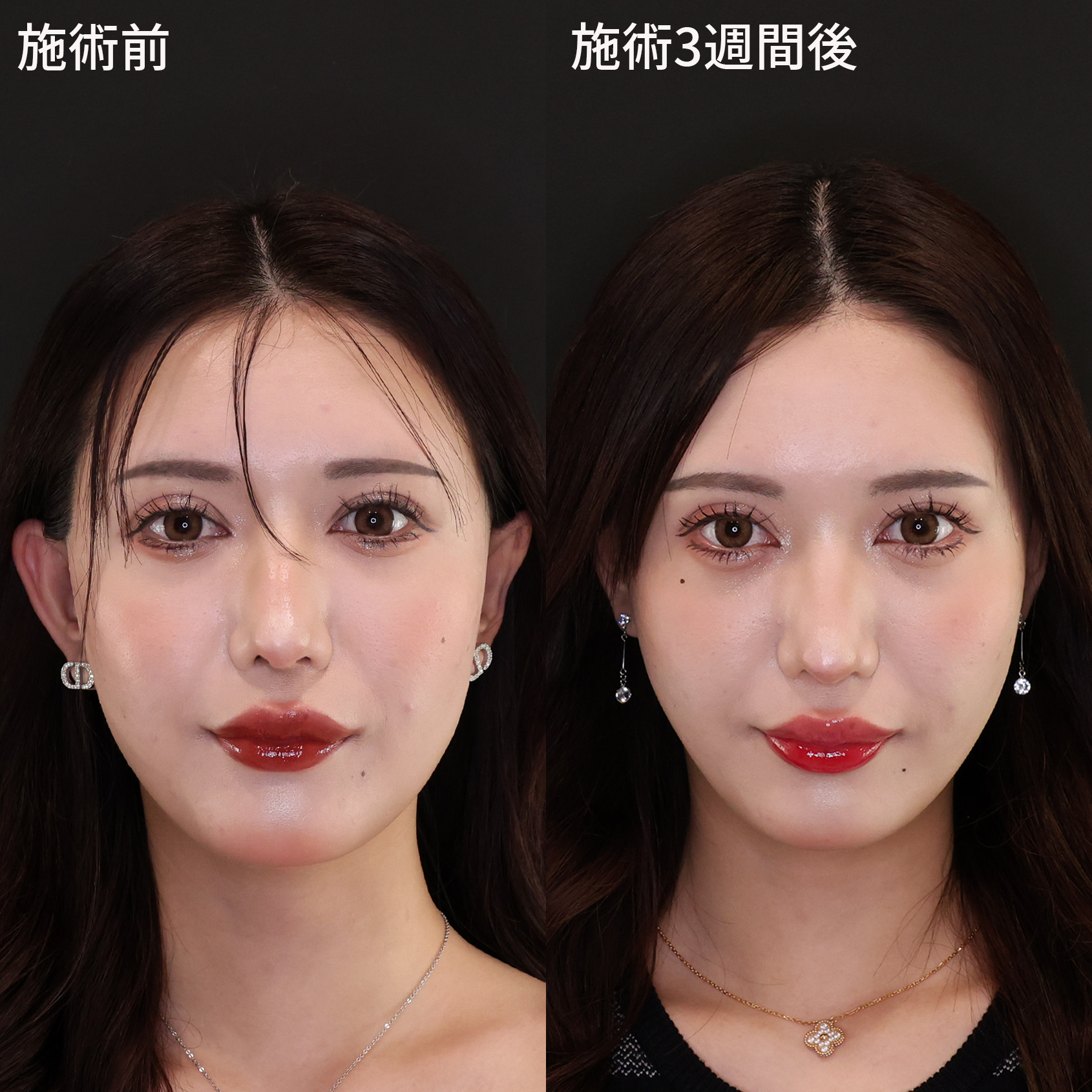 美しさに磨きをかけるDr.石橋の小顔術！【糸リフト×メーラーファット除去】