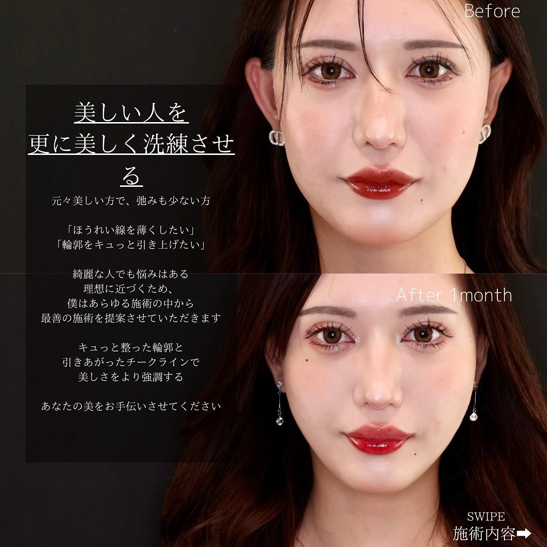 TAC式 ツヤ肌コラーゲンリフト®/メーラーファット除去の症例写真 施術前後 