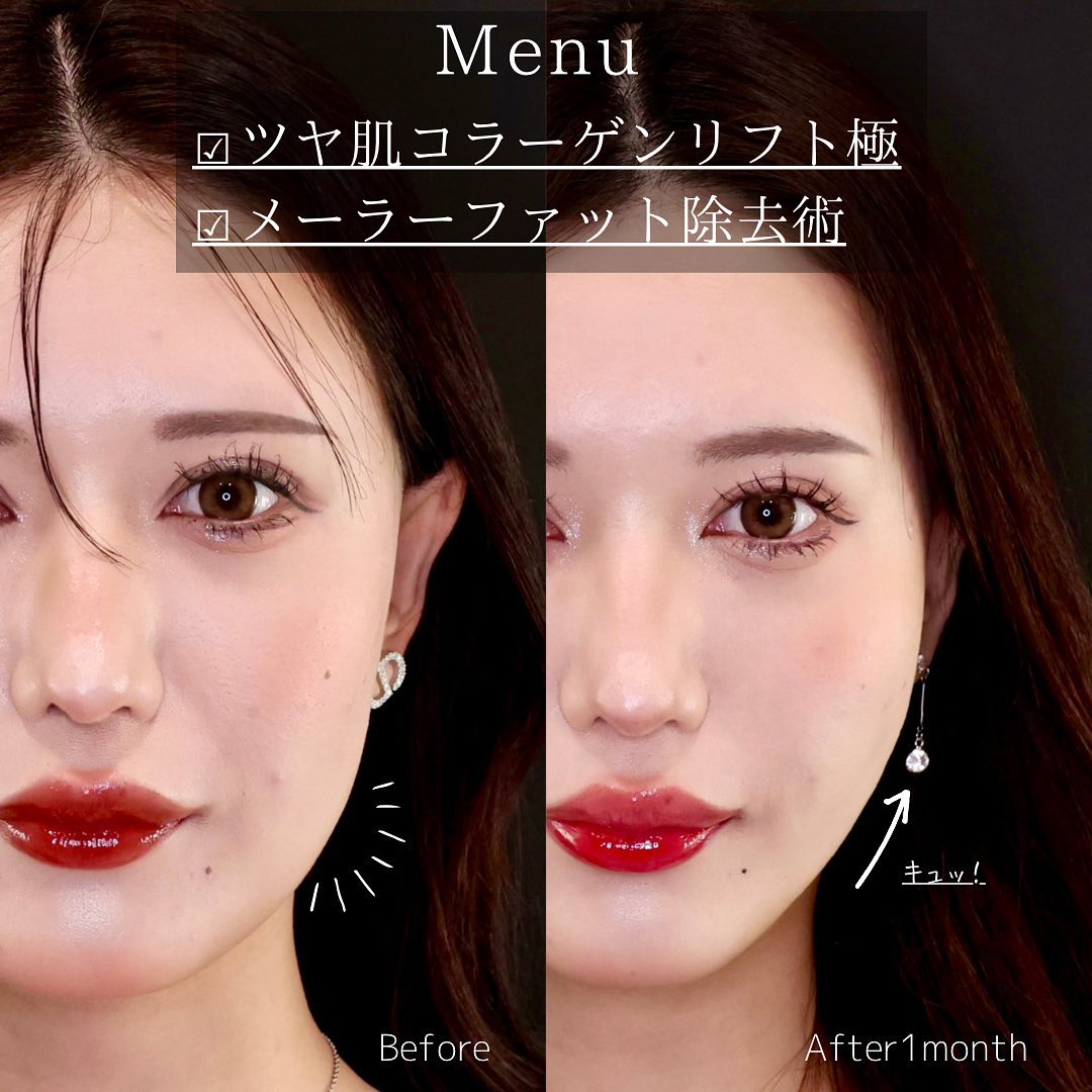 TAC式 ツヤ肌コラーゲンリフト®/メーラーファット除去の症例写真 施術前後 