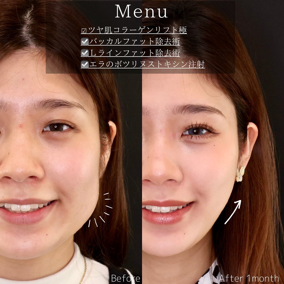 TAC式 ツヤ肌コラーゲンリフト®/バッカルファット除去/Lラインファット除去（エラ下脂肪除去）の症例写真 施術前後 