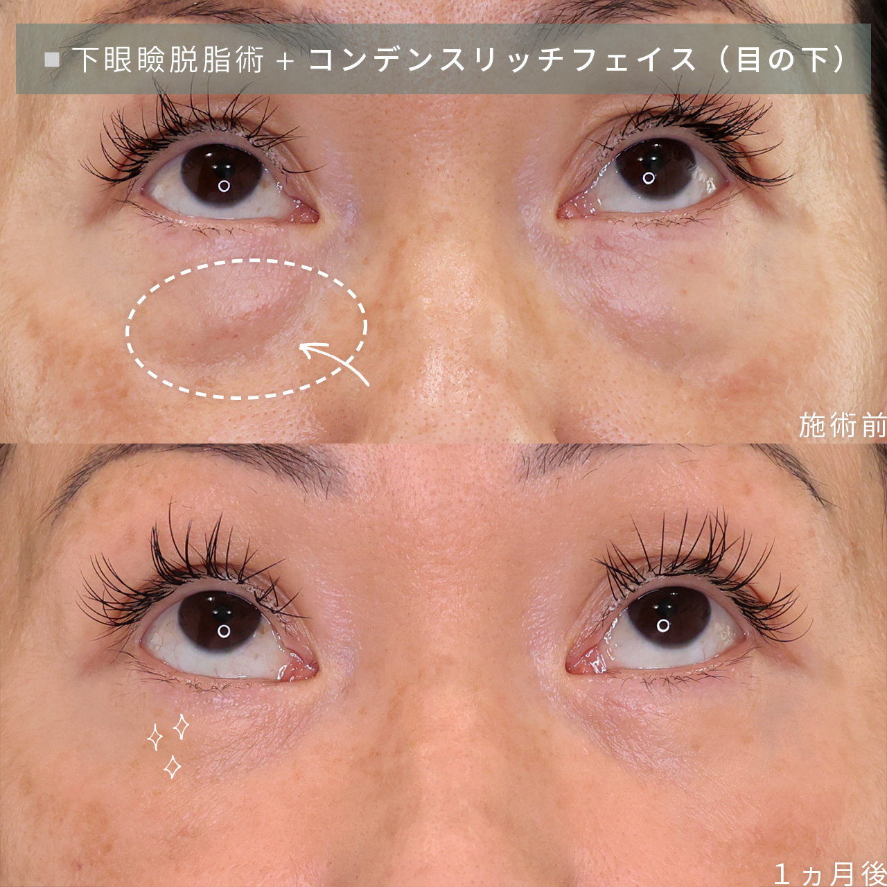 下眼瞼脱脂術（目の下のたるみ取り・目の下の脂肪ふくらみ取り）/顔の脂肪注入(コンデンスリッチフェイス)の症例写真 施術前後 
