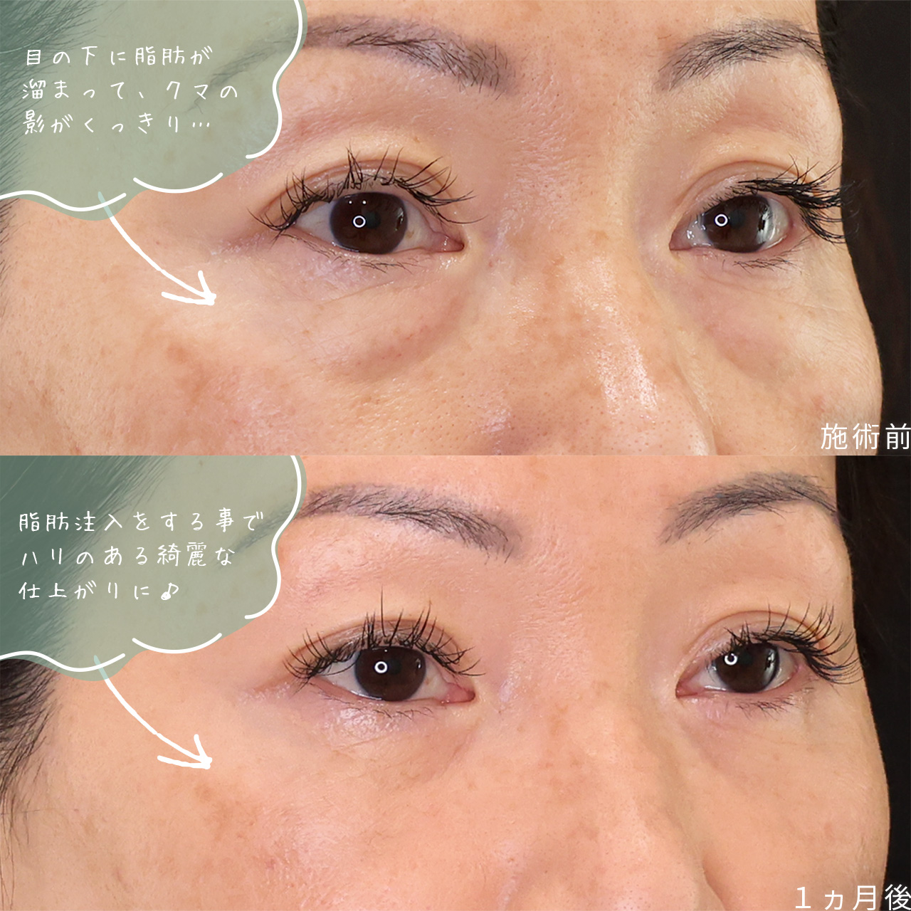下眼瞼脱脂術（目の下のたるみ取り・目の下の脂肪ふくらみ取り）/顔の脂肪注入(コンデンスリッチフェイス)の症例写真 施術前後 