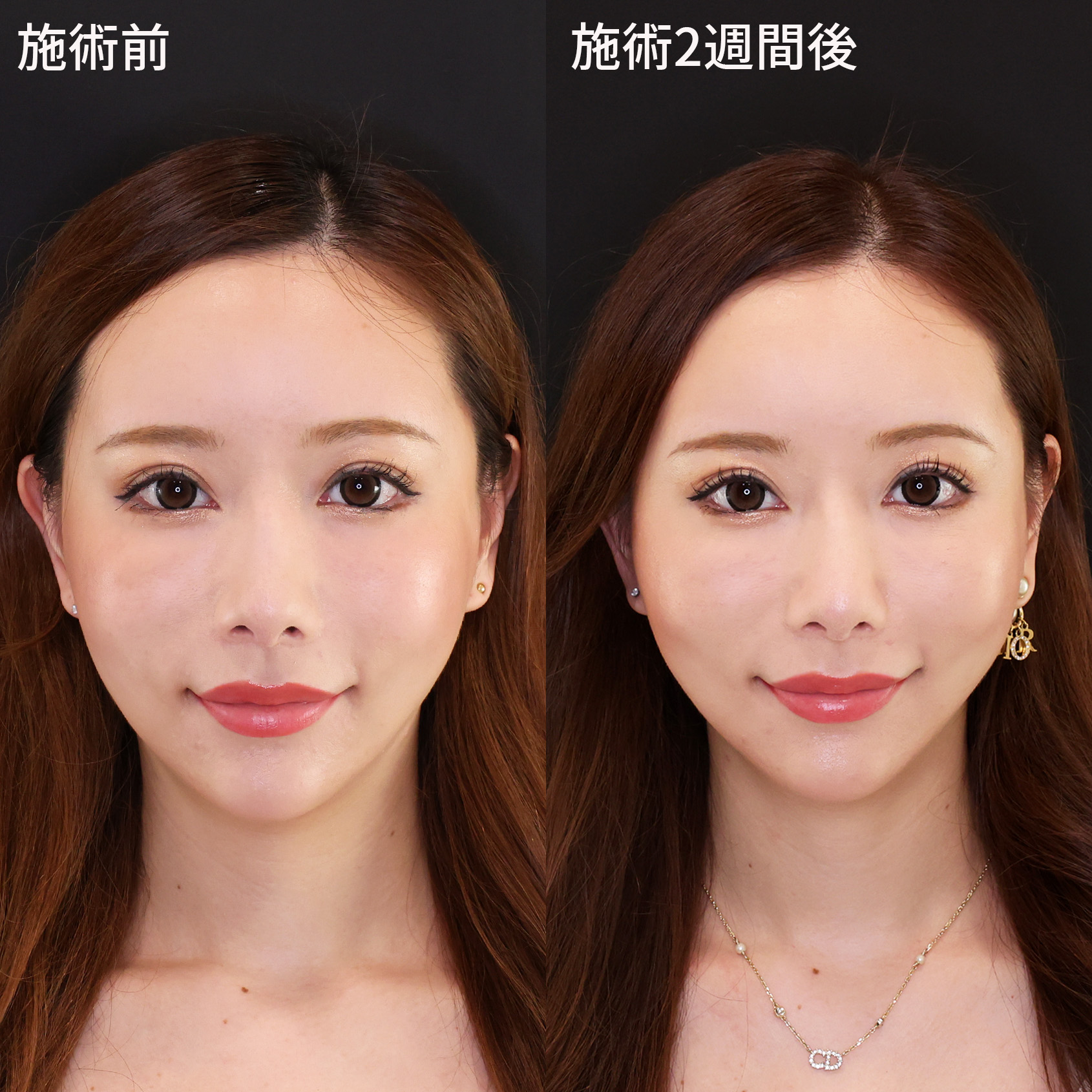 究極小顔術！【糸リフト】で女優級の小顔をつくる！