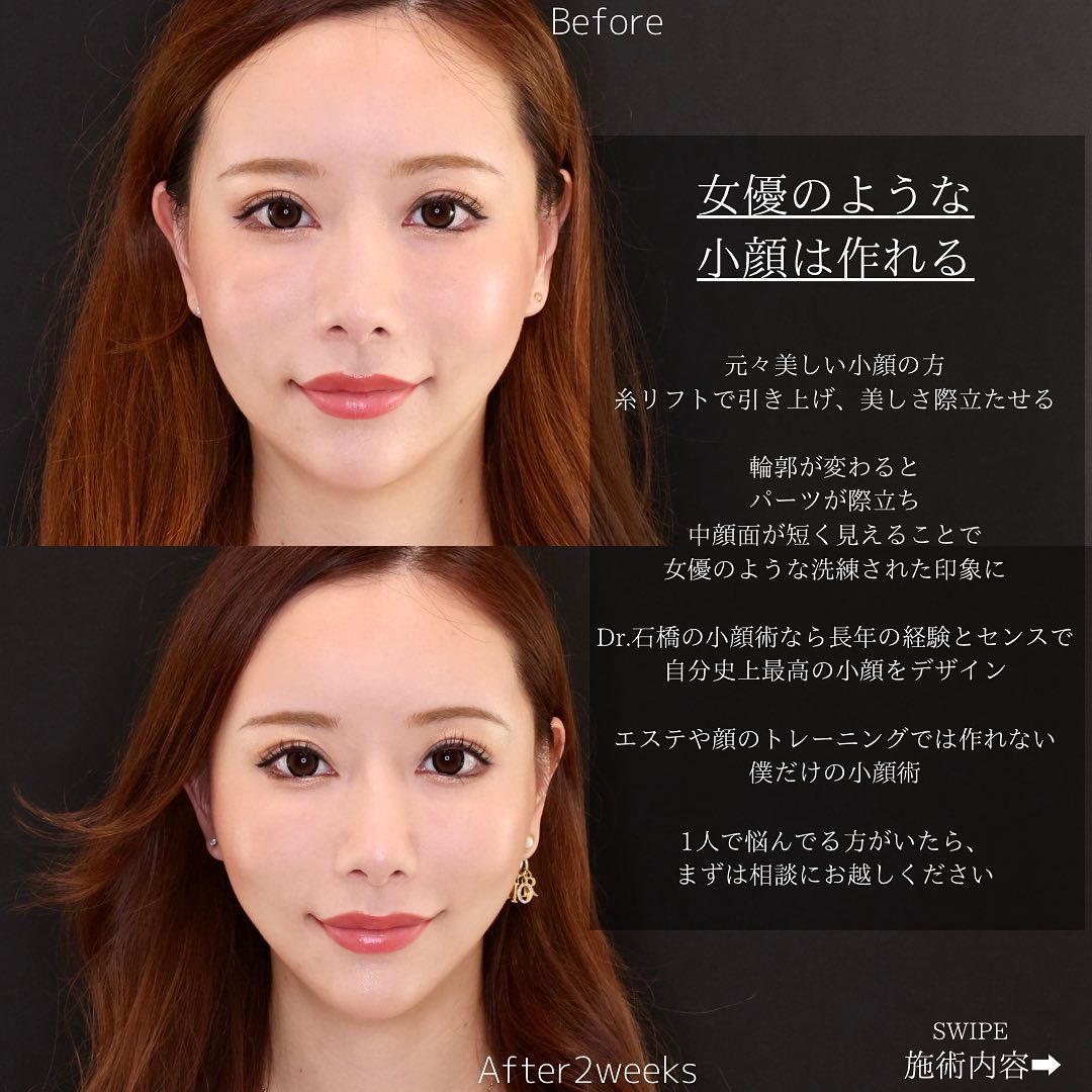 TAC式 ツヤ肌コラーゲンリフト®の症例写真 施術前後 