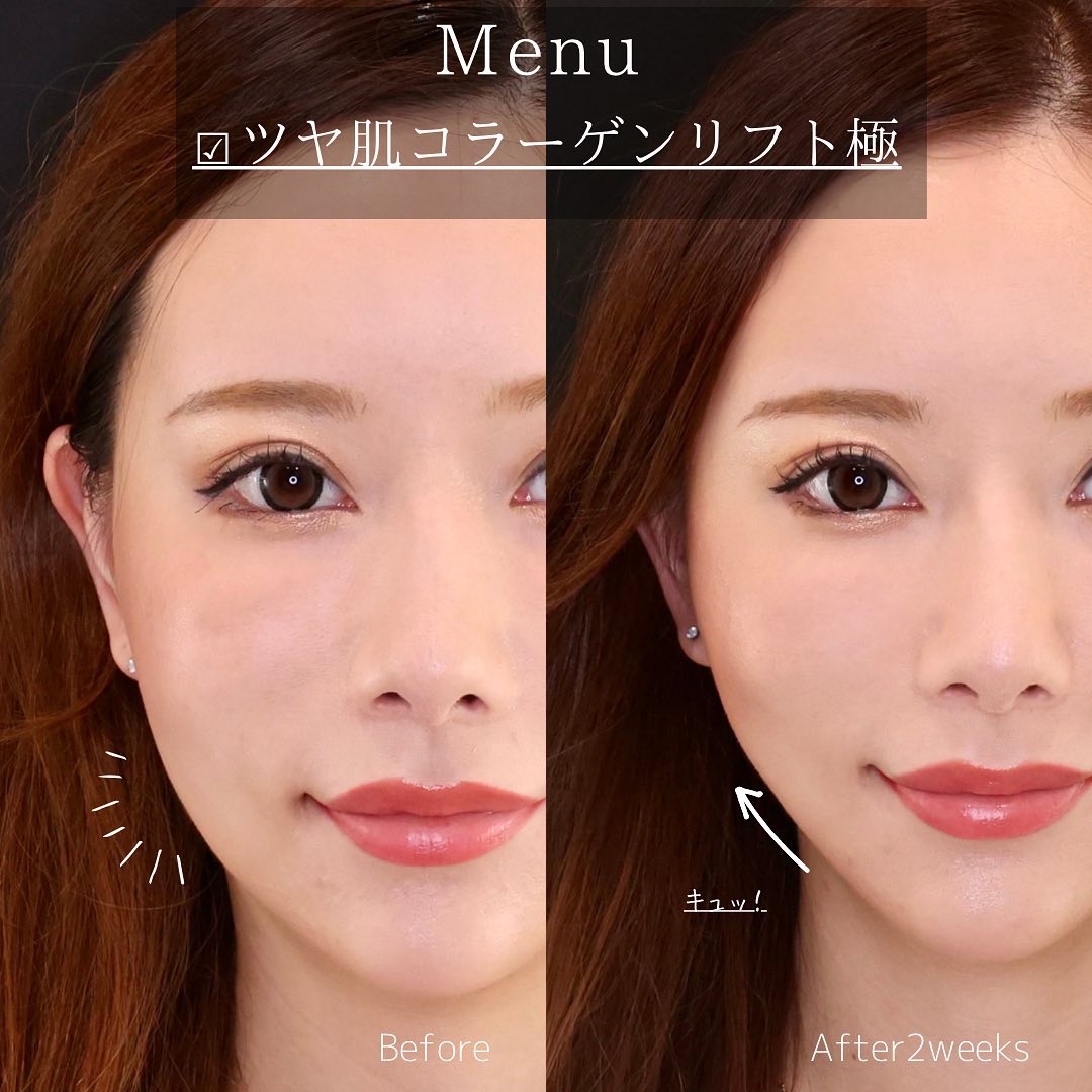 TAC式 ツヤ肌コラーゲンリフト®の症例写真 施術前後 