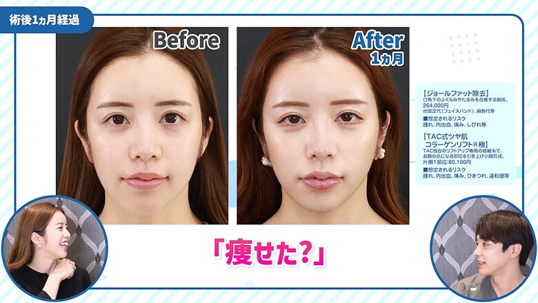 施術1カ月後の正面比較の症例写真