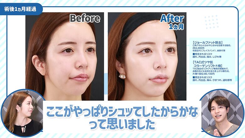 斜め横から見た1カ月後の症例写真を比較