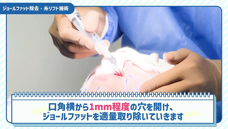 口角横から1mm程度の穴を開けて脂肪を除去