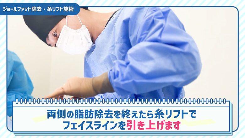 脂肪除去後に糸リフトでフェイスラインを引き上げる