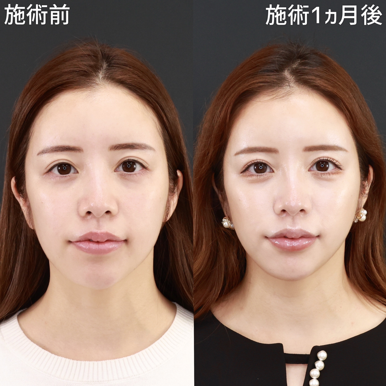 ジョールファット除去/TAC式 ツヤ肌コラーゲンリフト®の症例写真 施術前後
