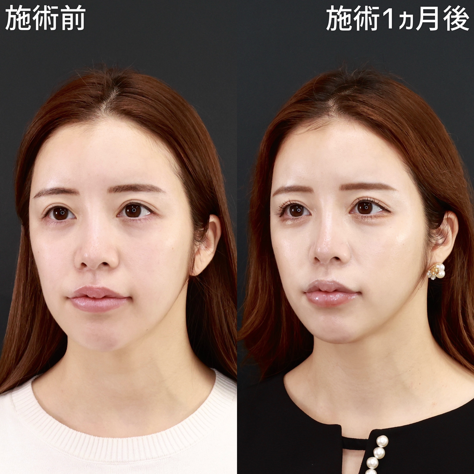 ジョールファット除去/TAC式 ツヤ肌コラーゲンリフト®の症例写真 施術前後