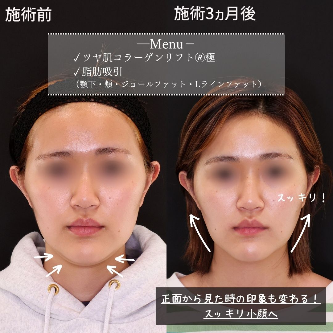 TAC式 ツヤ肌コラーゲンリフト®/ジョールファット除去/Lラインファット除去（エラ下脂肪除去）の症例写真 施術前後 
