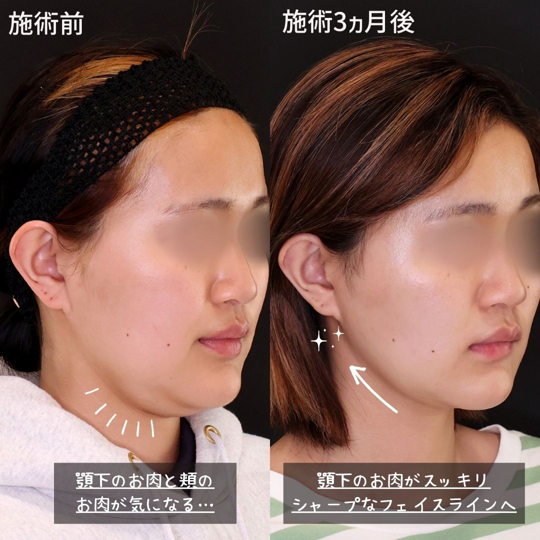 TAC式 ツヤ肌コラーゲンリフト®/ジョールファット除去/Lラインファット除去（エラ下脂肪除去）の症例写真 施術前後 