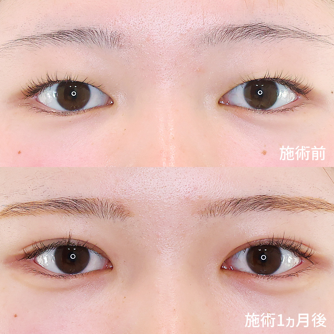 二重埋没法の症例写真 施術前後