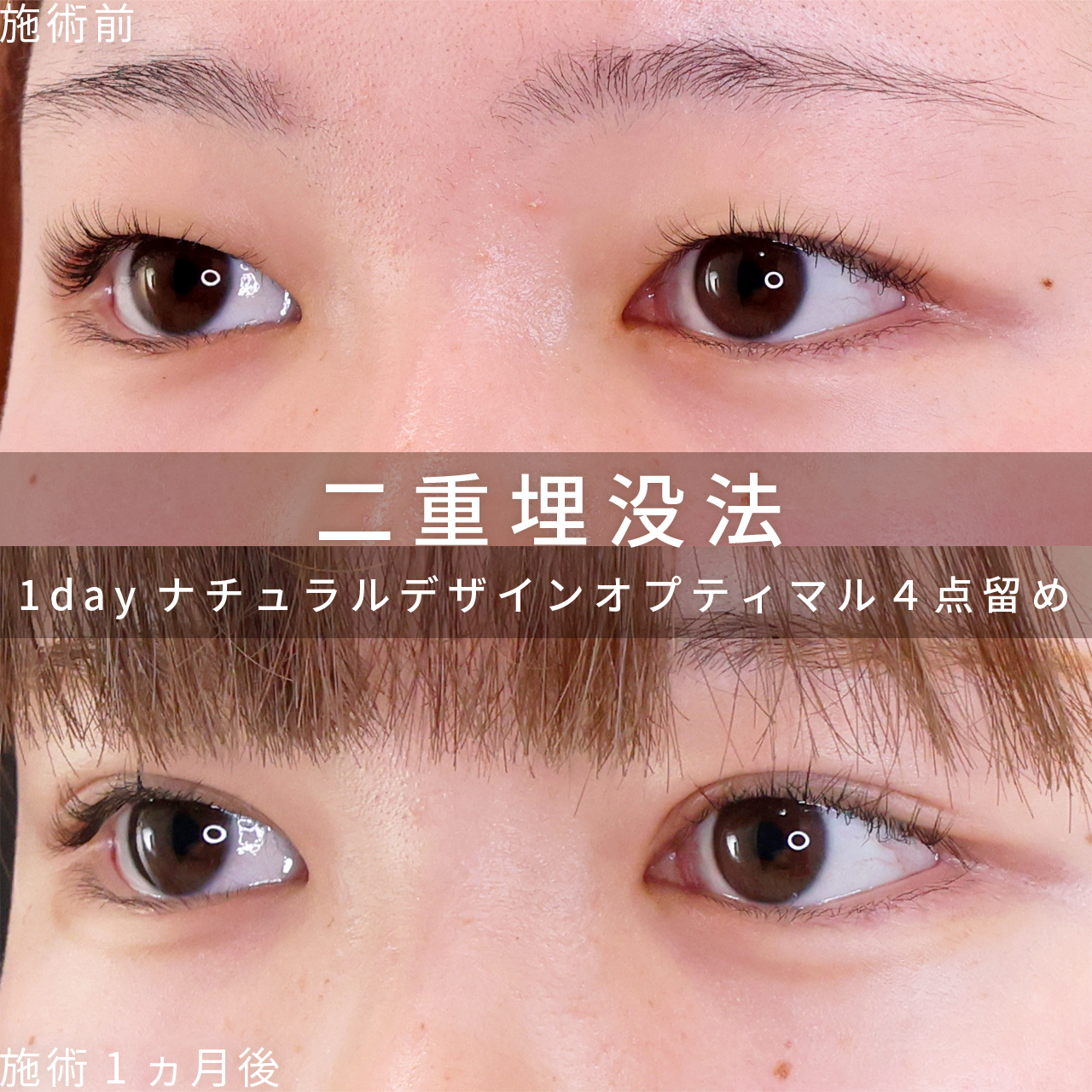 二重埋没法の症例写真 施術前後