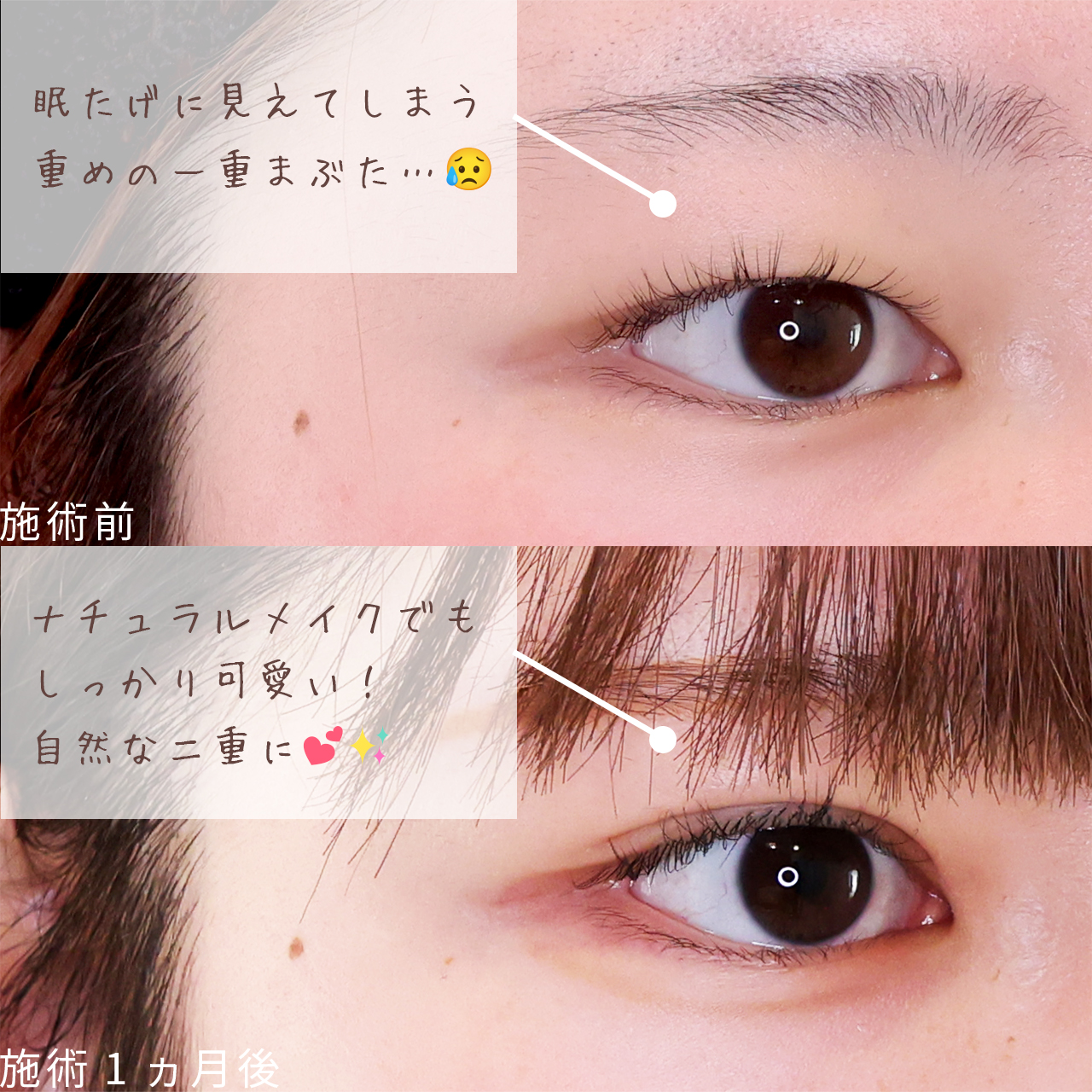 二重埋没法の症例写真 施術前後