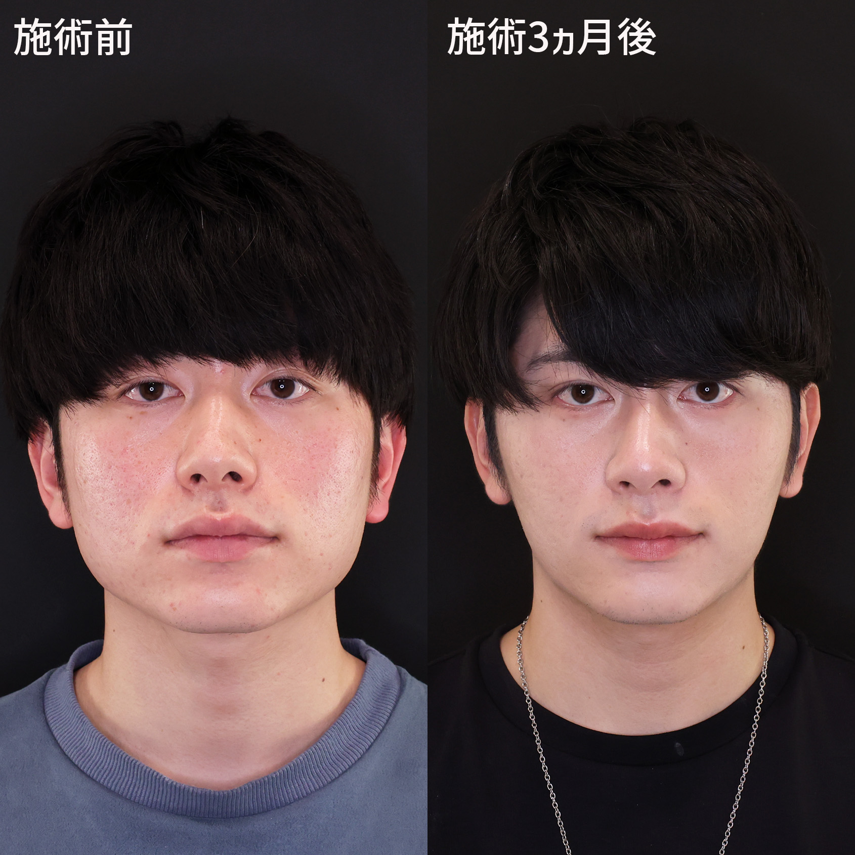 メンズ整形でグッと垢抜け！【糸リフト×脂肪除去】でモテフェイスへ！